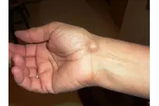 Bilekte Şişlik Nasıl Anlaşılır?