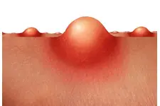 Genital Bölgede Şişlik Belirtileri ve Tedavisi