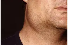 Sol Kulak Altında Şişlik Belirtileri ve Tedavisi