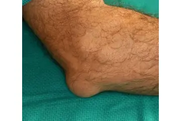 Dirsekteki Şişlik Nedenleri?