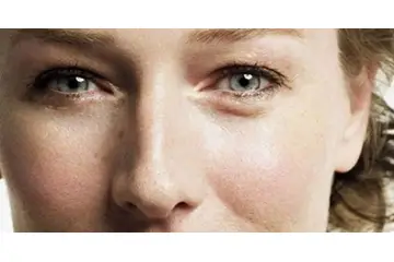 Göz Altı Şişliği Nedenleri