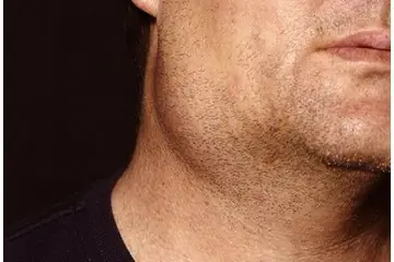 Sol Çene Altında Şişlik Belirtileri ve Tedavisi